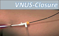 Video VNUS-Closure-Behandlung